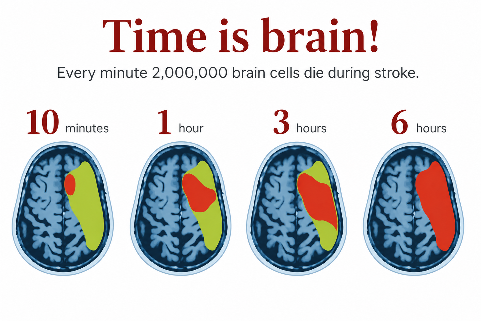 Time is brain — neurons lost as stroke treatment is delayed